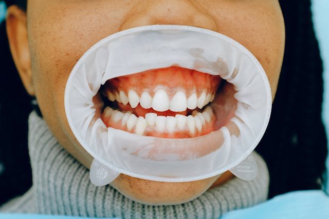 Can You Whiten Teeth with Gum Recession?