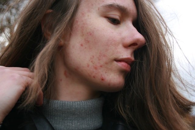 Inositol and Acne: Its Potential Benefits for Skin Health